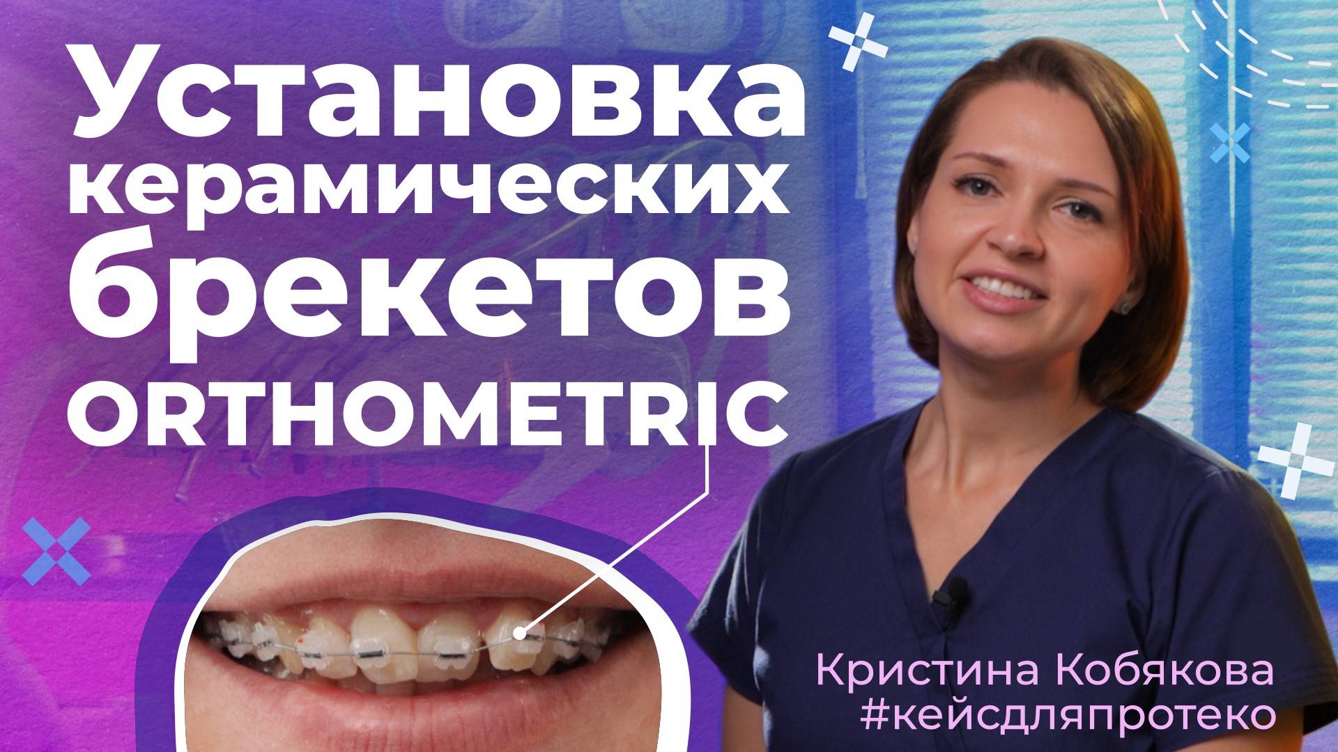 Установка НЕВИДИМЫХ брекетов #orthometric