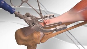 Achilles Tendon Rupture Repair with Arthrex® PARS System