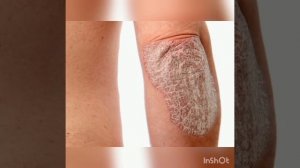 КАК ОТЛИЧИТЬ ПСОРИАЗ ПСОРИАЗ ОТ ЭКЗЕМЫ