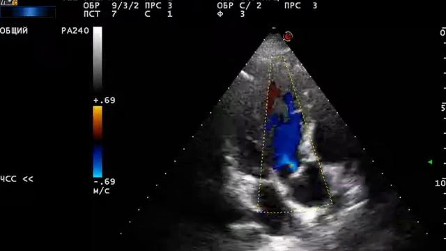 аортальная недостаточность смотреть онлайн