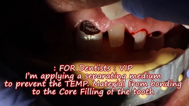 Need a Tooth Implant Alternative? See How Dentist save teeth with Crown and Filling смотреть онлайн