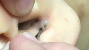 Огромные Черные Точки в ухе