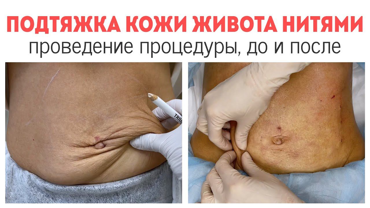 Нити в живот | Подтяжка кожи живота с помощью нитевого лифтинга