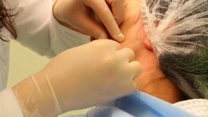 Тредлифтинг 3D-мезонитями