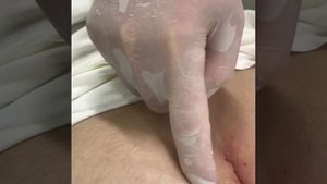 Эпителиальный копчиковый ход