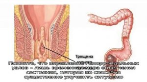 Можно ли самостоятельно вправить геморроидальный узел