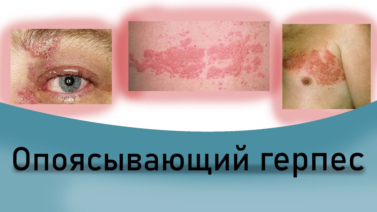 Опоясывающий герпес