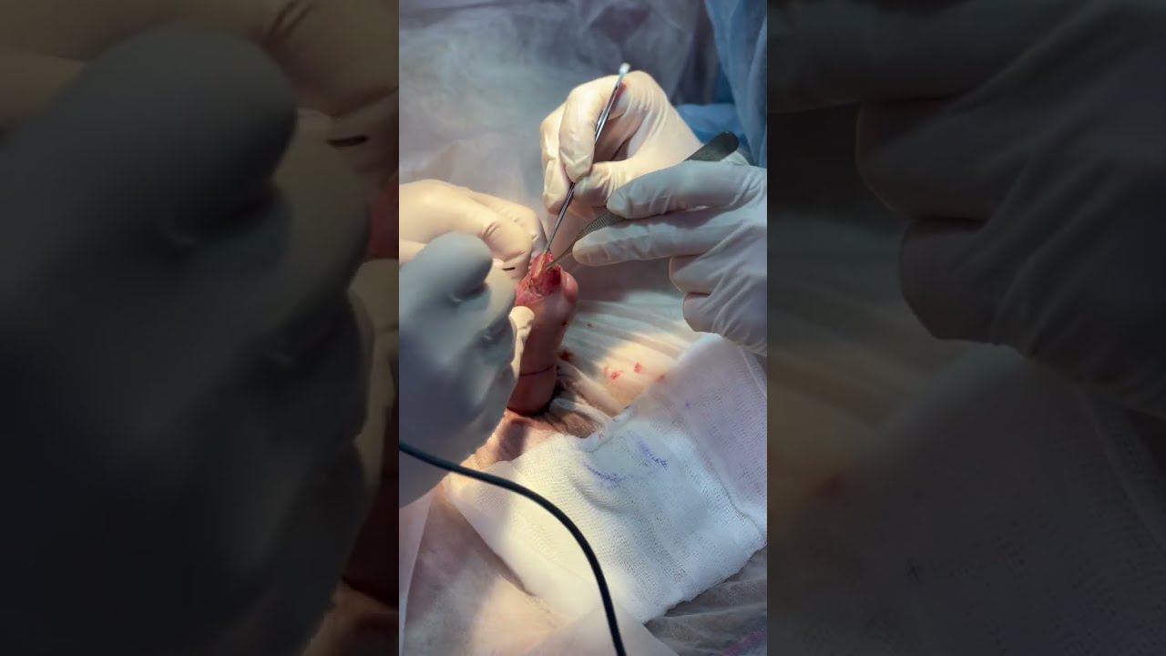 Выраженный #фимоз. Пациент  70+.  Операция циркумцизия. #урология #обрезание #фимоз #доценко