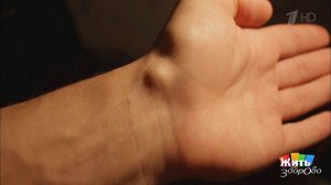 Библейская киста. Гигрома. Жить здорово! Фрагмент выпуска от 04.02.2020