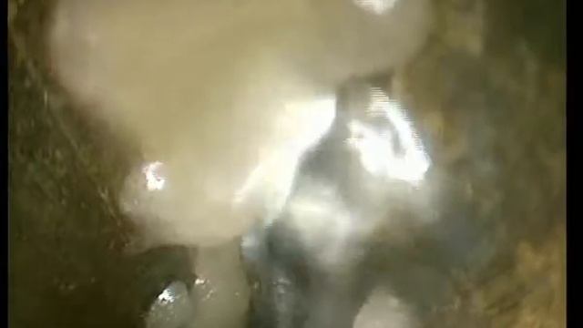 фасциотомия
