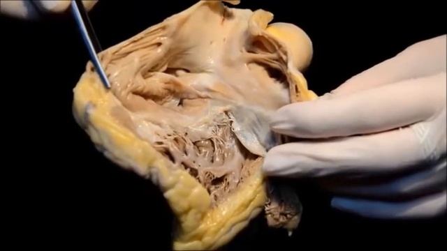 Строение сердца. Правое предсердие. смотреть онлайн