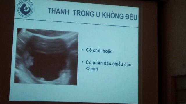 Mô tả khối U phần phụ IOTA- BS Lan смотреть онлайн