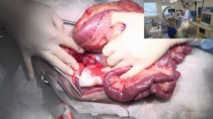 Удаление надпочечника