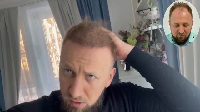 ПОДСТРИГСЯ КОРОТКО ПОСЛЕ ПЕРЕСАДКИ ВОЛОС l СЛЕДЫ ПОСЛЕ ПЕРЕСАДКИ ВОЛОС В ТУРЦИИ смотреть онлайн