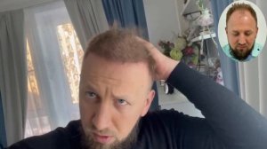 ПОДСТРИГСЯ КОРОТКО ПОСЛЕ ПЕРЕСАДКИ ВОЛОС l СЛЕДЫ ПОСЛЕ ПЕРЕСАДКИ ВОЛОС В ТУРЦИИ