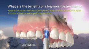 Straumann Implant Импланты Штрауман