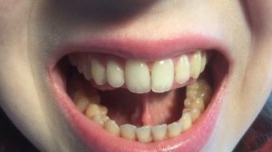 Растягивание подъязычной уздечки: упражнения, лёгкий массаж