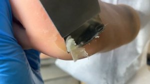 Callus removal from feet&Foot scraping dead skin【Xiao Yan pedicure】#stress 78