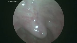 Иногда папиллому кончика язычка можно не заметить на осмотре из-за её прилипания к язычку?♂️