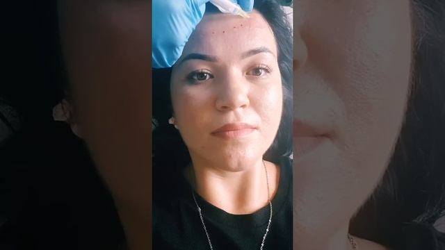 Укол красоты?Гиалуроновая кислота смотреть онлайн