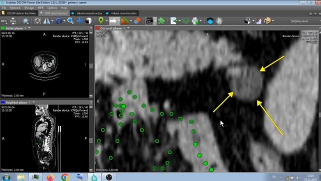 ВНУТРЕННИЕ ГРЫЖИ . ГРЫЖА СВЯЗКИ ТРЕЙТЦА НА ПЭТ КТ .Treitz's ligament hernia