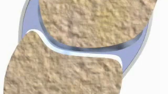 Артроз (eng) смотреть онлайн