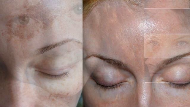 Вся Правда о Пятнах Над Губой? смотреть онлайн