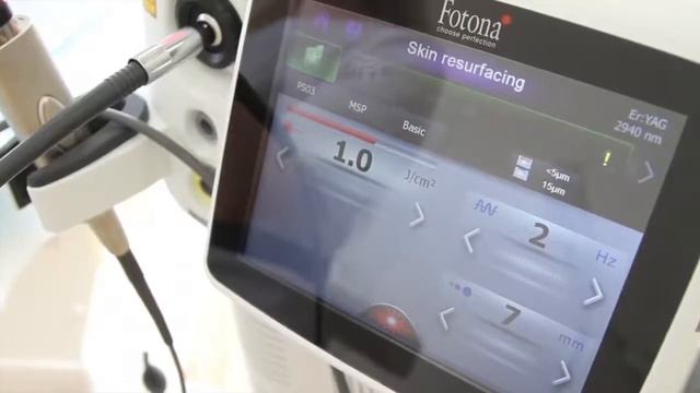 ВитаСПА Лазерная полировка смотреть онлайн