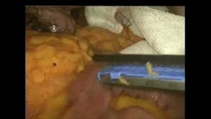 Лапароскопическое мини-гастрошунтирование (ЛМЖШ).