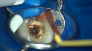 furcation perforation closure . закрытие  фуркационной  перфорации