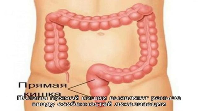 Особенности гиперпластических полипов