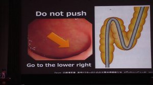21 T Kawamura Скрининг колоректального рака и японский подход к проведению колоноскопии