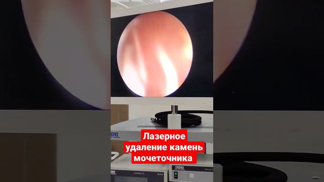 Лазерное удаление камень из мочеточника