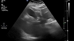 УЗИ печени. Есть кисты. Вы хорошо разбираетесь в сегментах?