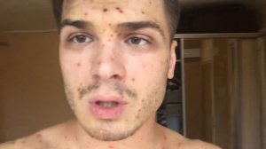 МОЖНО ЛИ ЗАБОЛЕТЬ ВЕТРЯНКОЙ ВТОРОЙ РАЗ?