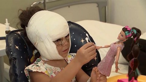 Российские врачи провели очередную операцию американской девочке с большим родимым пятном на лице