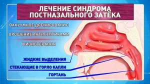 Лечение синдрома постназального затека