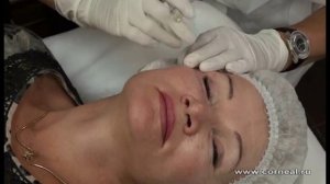 Биоревитализация области вокруг глаз