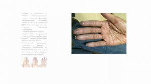 Системная склеродермия, склеродермия, линейная склеродермия