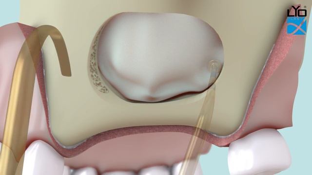 Пластика перфорации мембраны Шнейдера или профилактика перфорации при синус-лифтинге смотреть онлайн