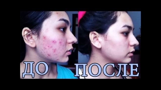 Пивные дрожжи от прыщей - опыт применения, результаты, отзывы смотреть онлайн