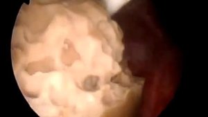 Дробление камней в почках лазером