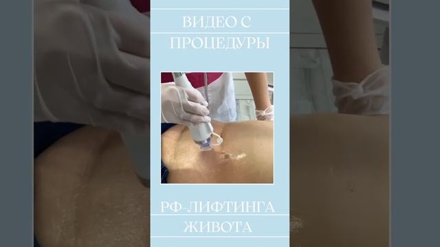 Процесс Микроигольчатого RF-лифтинга на живот #косметологекатеринбург #омоложениекожи #рфлифтинг
