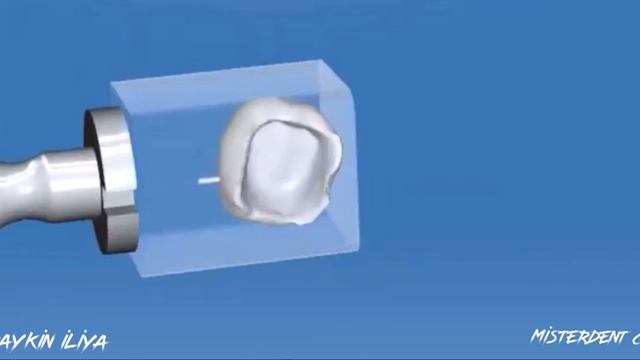 Временная коронка на зуб , провизорная реставрация на зуб , пластиковая временная коронка на зуб смотреть онлайн