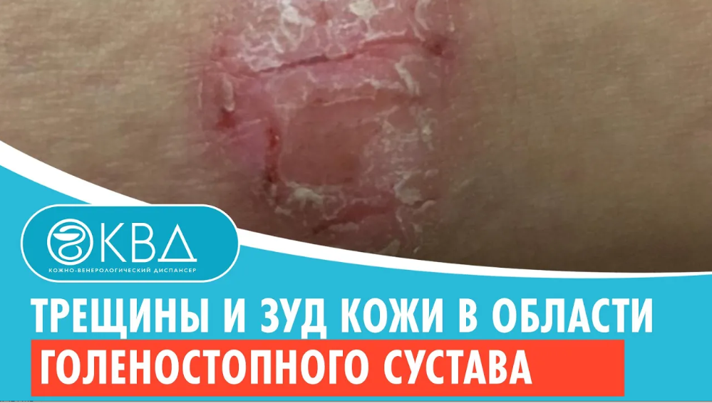 ? Трещины и зуд кожи в области голеностопного сустава. Клинический случай №567