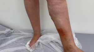 Варикоз голени с трофическими расстройствами. Флеболог Москва