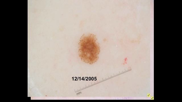 Melanoma specific criteria by Dr. A. Marghoob