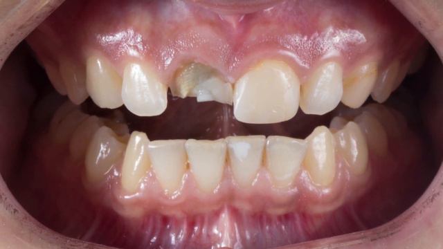 Препарирование зубов , керамические коронки , подготовка зубов под виниры , зубы под виниры ,лечени смотреть онлайн