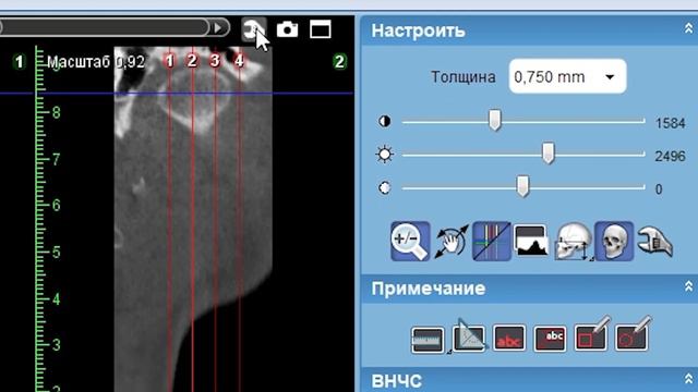 Возможности программы Romexis Viewer: просмотр ВНЧС смотреть онлайн