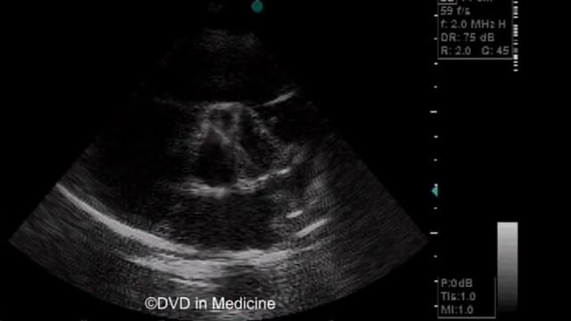 Echocardiography for beginners - the best смотреть онлайн